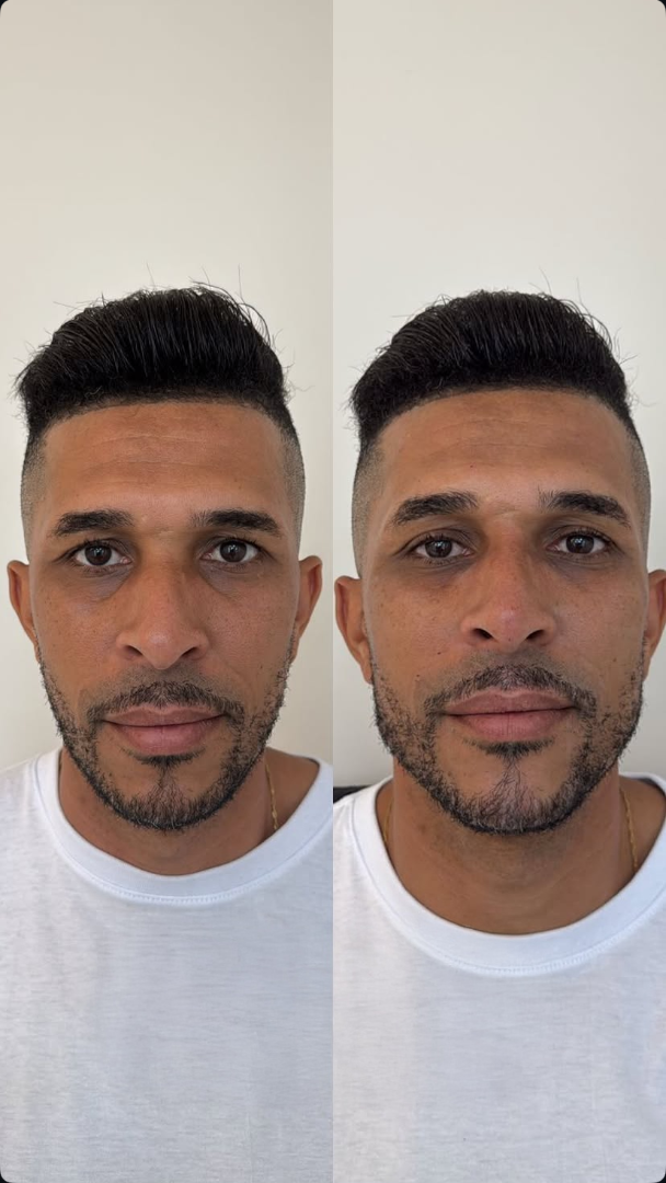 Antes e depois de harmonização facial masculina contorno de mandíbula definido